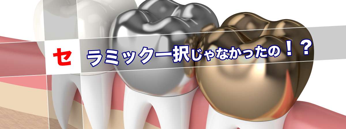 本職歯科医師が金歯を選ぶ理由 セラミック一択じゃないの オレ歯科 Com